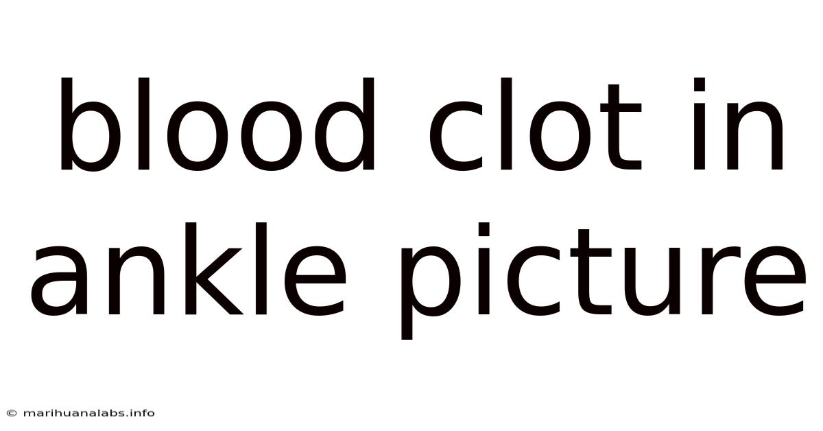 Blood Clot In Ankle Picture