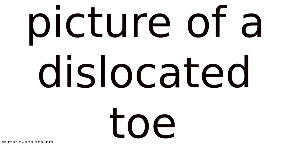 Picture Of A Dislocated Toe